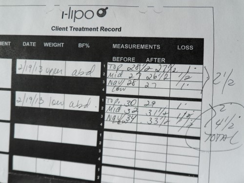 i-lipo before and after measurements