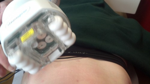 i-lipo suction treatment