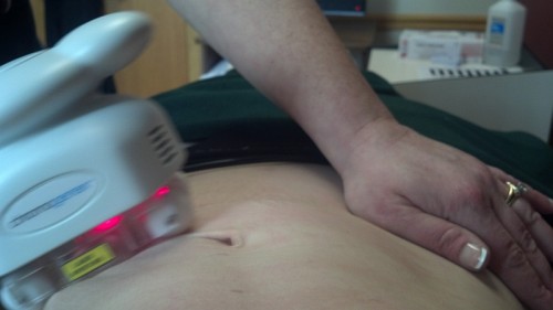 i-lipo suction treatment